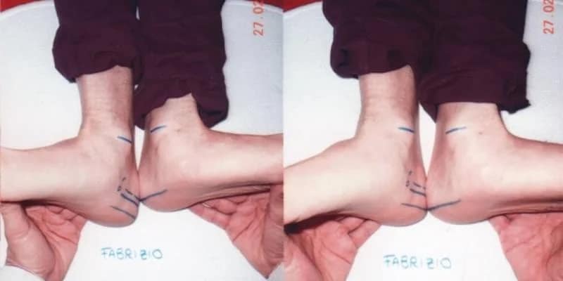 Fabry-Prima-Dopo Misurazioni Prima e Dopo